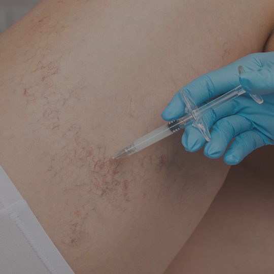 samsara-sclerotherapy